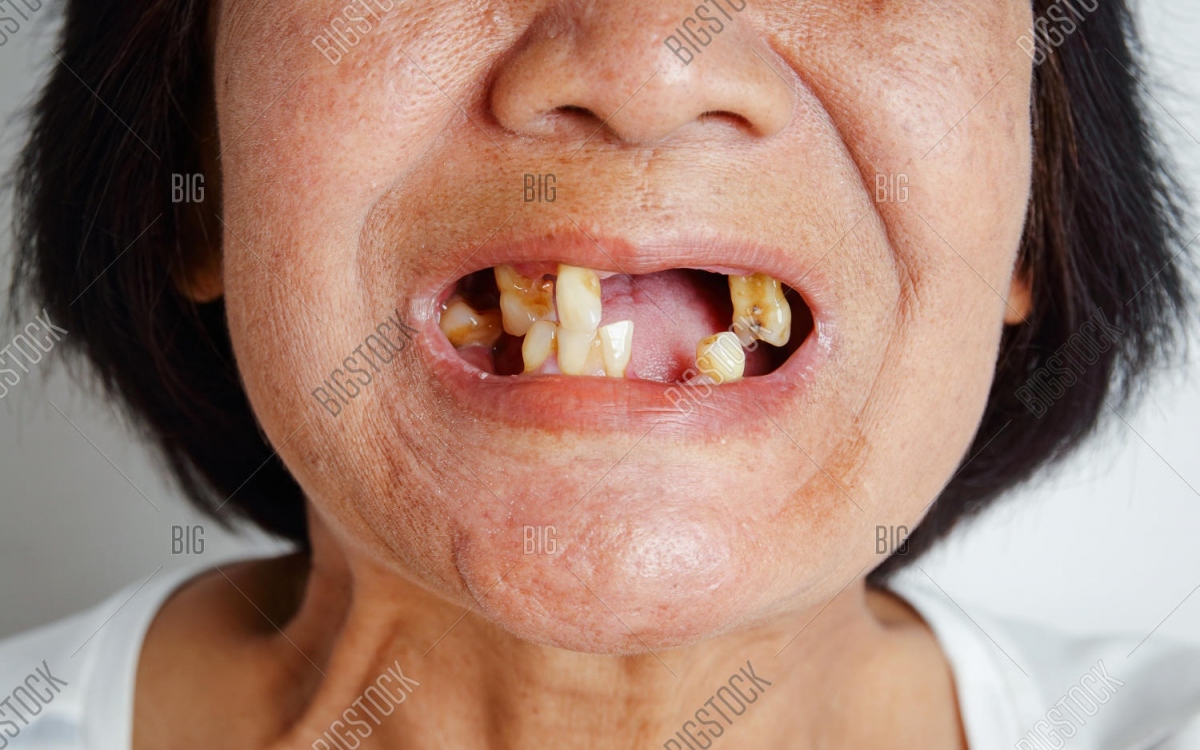 Tỷ lệ rụng răng trong người dân vùng Tây Thái Bình Dương là cao nhất